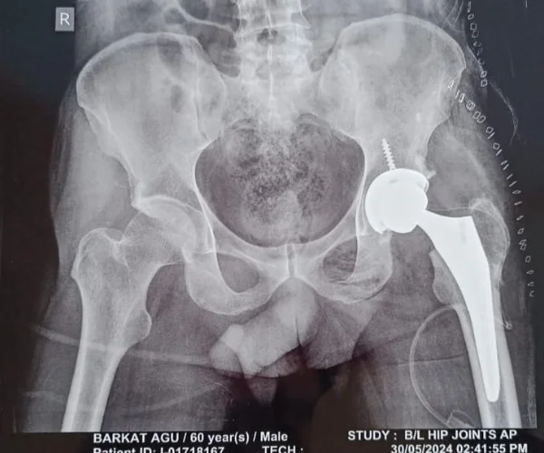 Total Hip Replacement Post Surgery